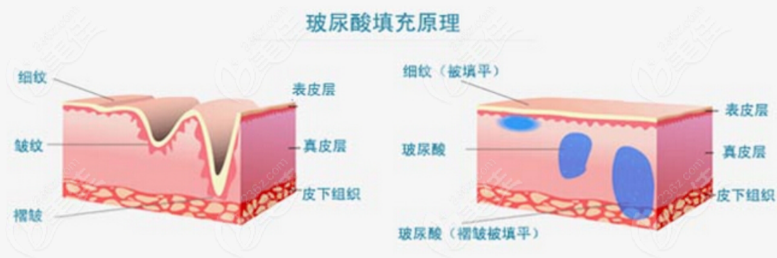 玻尿酸注射示意图