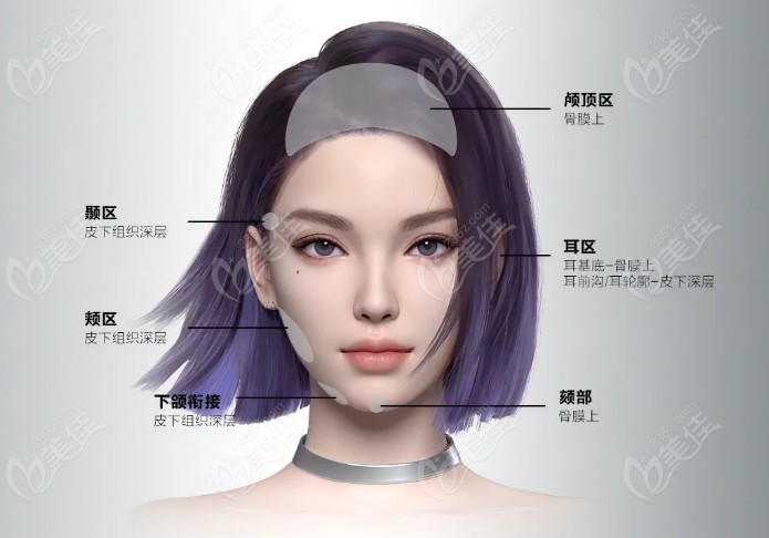 瑞娅玻尿酸适合填充哪里