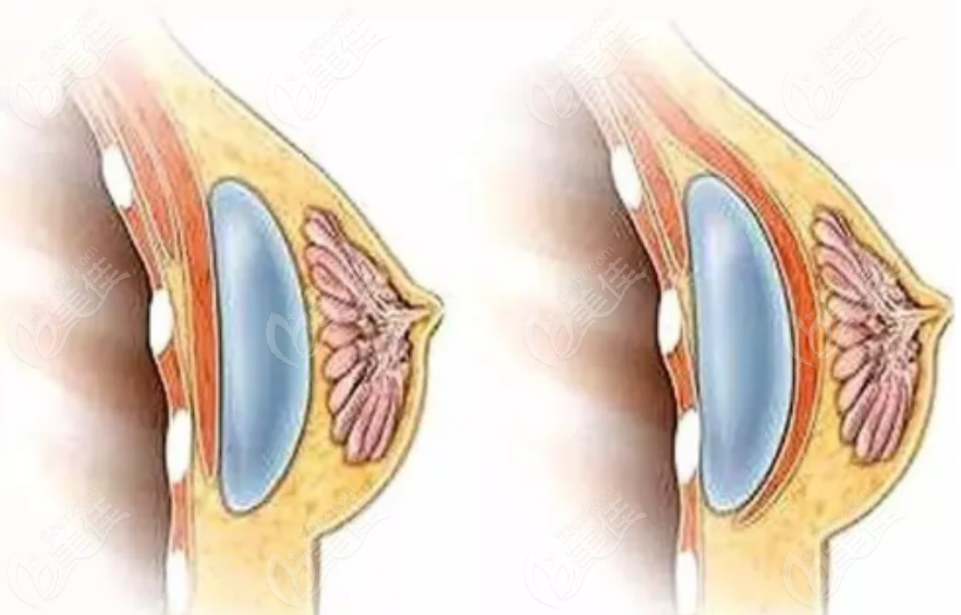 假体隆胸手术示意图