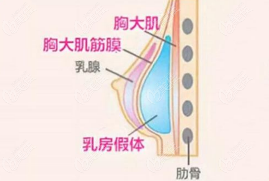 假体隆胸手术示意图