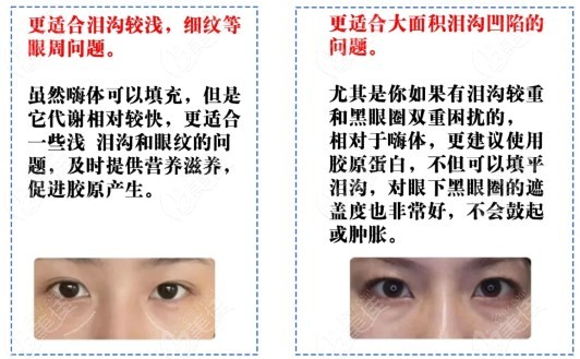 泪沟填充该选择嗨体熊猫针还是胶原蛋白