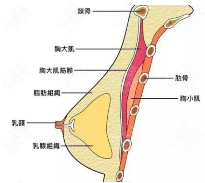 假体隆胸示意图