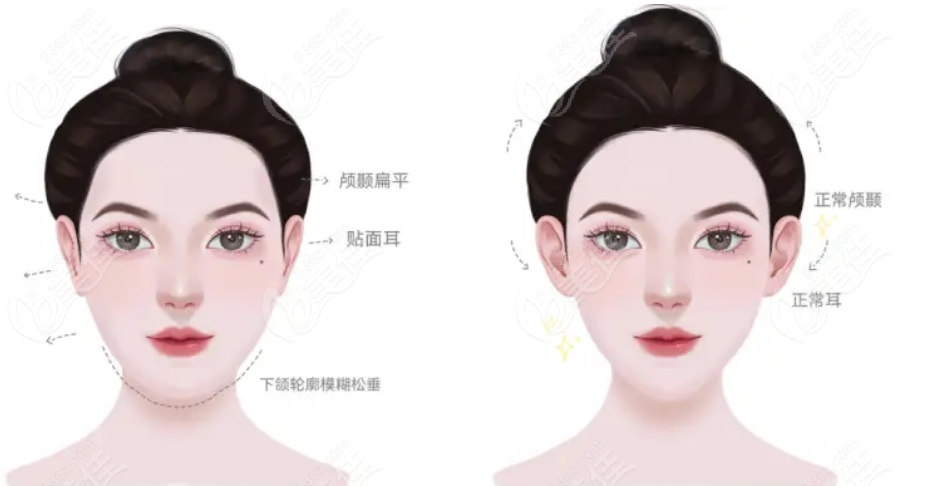 babyface凹陷填充对比明显