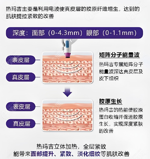 热玛吉改善干瘪型、松泡型面部衰老疗效好