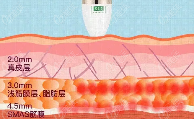 超声炮和水光可以一起做吗？不建议美佳网