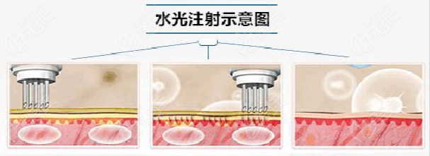 超声炮做完多久可以做水光？1个月左右