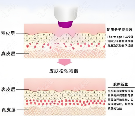 热玛吉有皮肤收缩、提拉、紧致功效