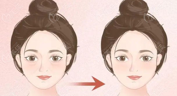 填充babyface正常操作是不会流到口角囊袋处
