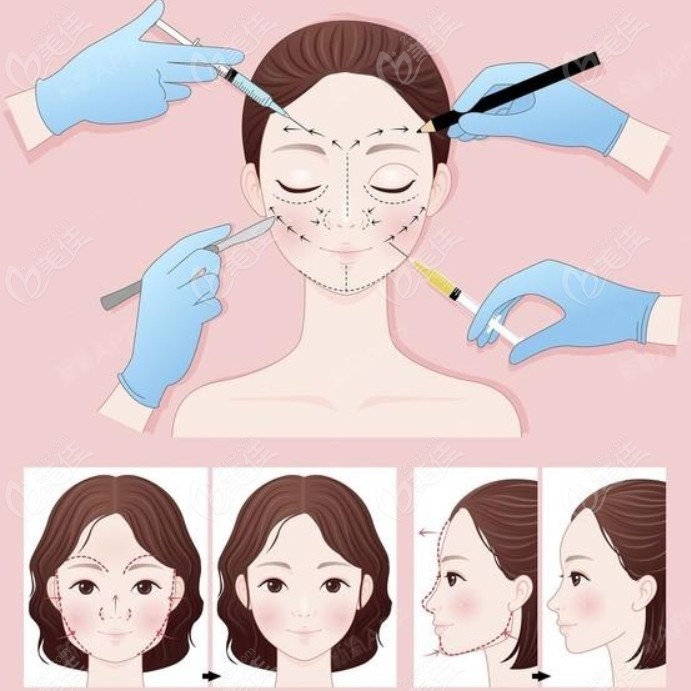 填充babyface后避免流向口角囊袋