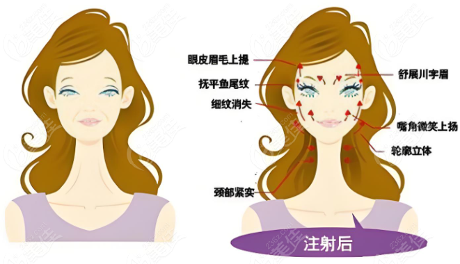 玻尿酸填充babycare前后对比图 m.236z.com