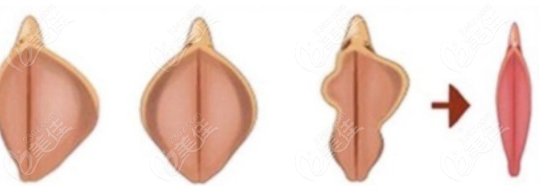 私密整形手術(shù) 私密整形手術(shù)