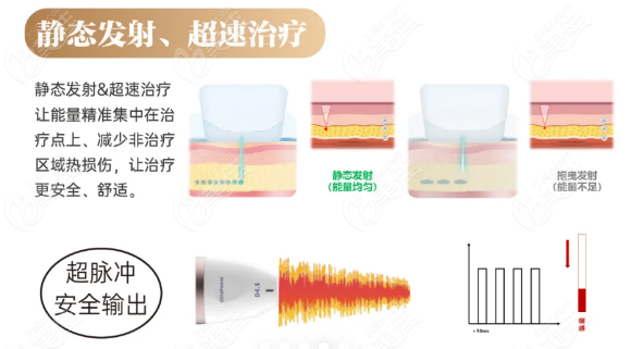 钻石超声炮技术优势与特点