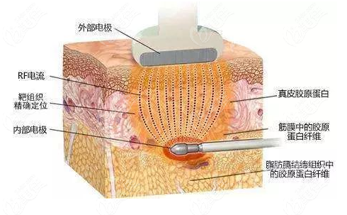 瘦脸光纤溶脂有用吗？光纤溶脂脸会不会松弛？