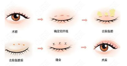 内眼角修复手术