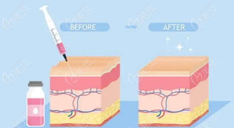 玻尿酸注射示意图