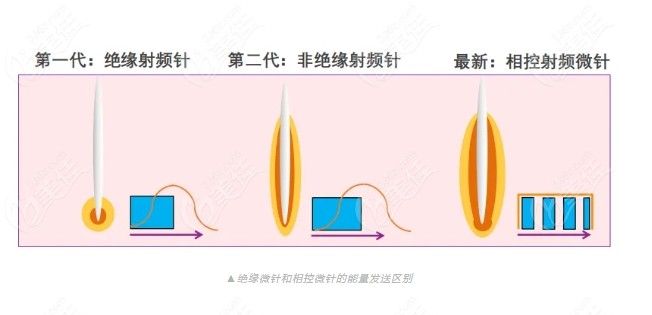 美迪迈黄金微针的针头粗痛感重