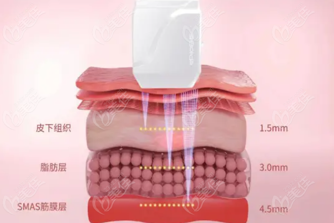 铂金超声炮是噱头吗？不是