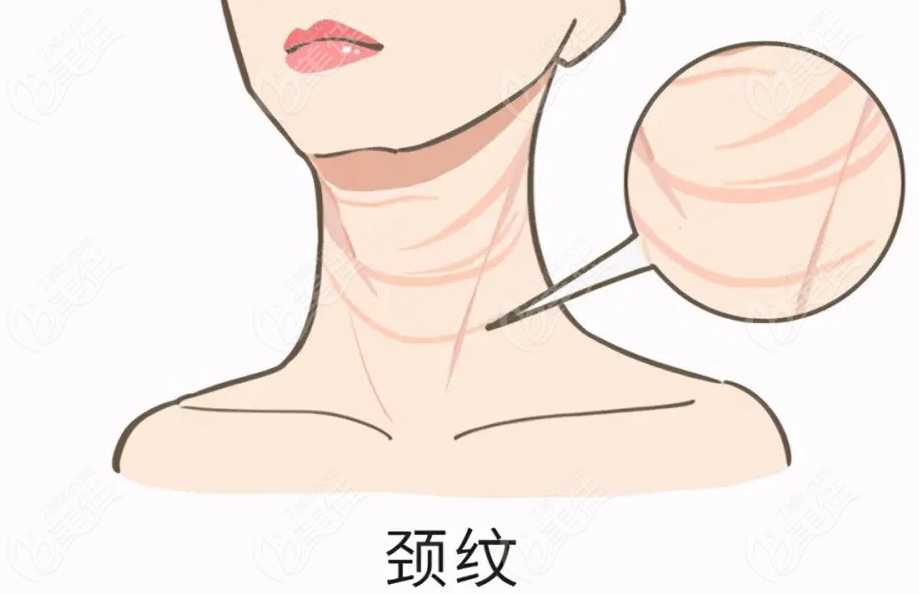 去颈纹用嗨体1.5还是2.5？重度颈纹用1.5，轻度用2.5,区别很大哦