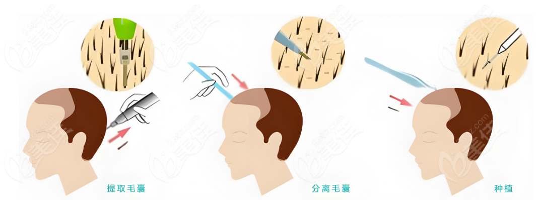 贵阳樊鹏飞植发医生简介:植发经验多、种植自然、植发价格还不贵,还不快冲 
