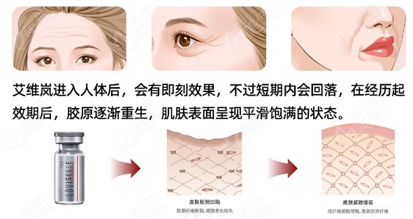 艾维岚童颜针填充面部凹陷