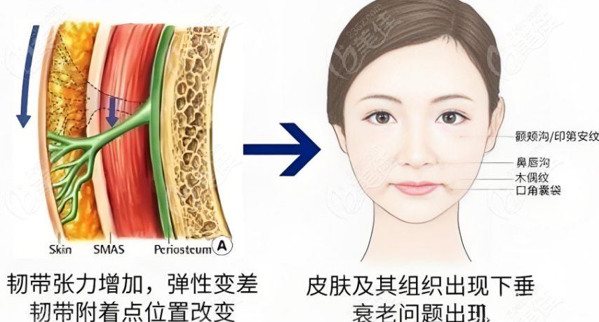 好医生做拉皮自然好看值得选择