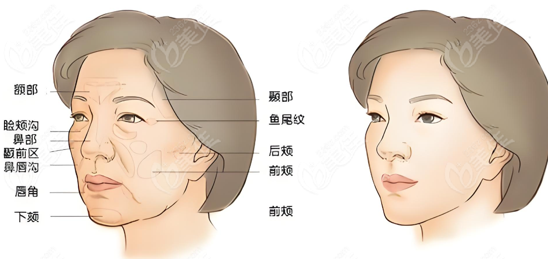 国内做拉皮技术好的医生排名推荐www.236z.com