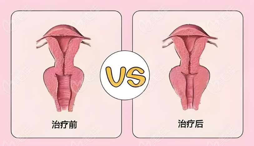 北京私密緊縮修復(fù)好的醫(yī)院縮陰前后對比圖