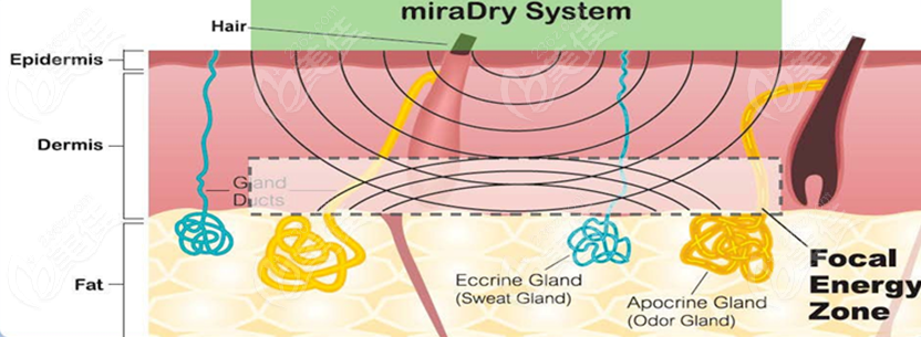 	miradry治疗狐臭并不是骗局!清新微波有根除腋臭的成效,还不会留疤