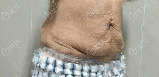 展望医生腹壁整形怎么样