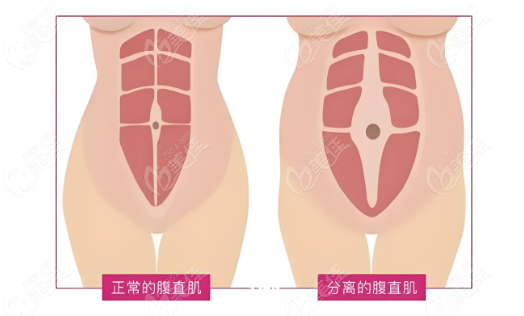 展望腹壁成效图