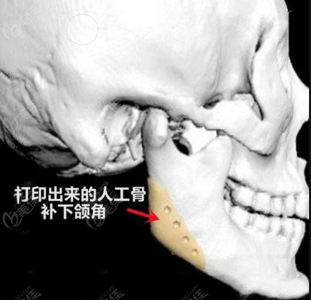 3d打印人工骨修复颧骨下颌角医院