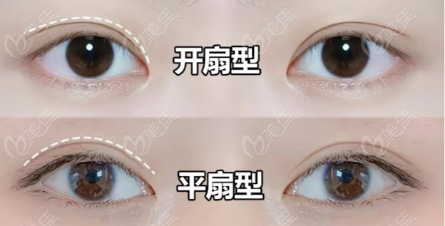 成都素美杨迪双眼皮实例图分享