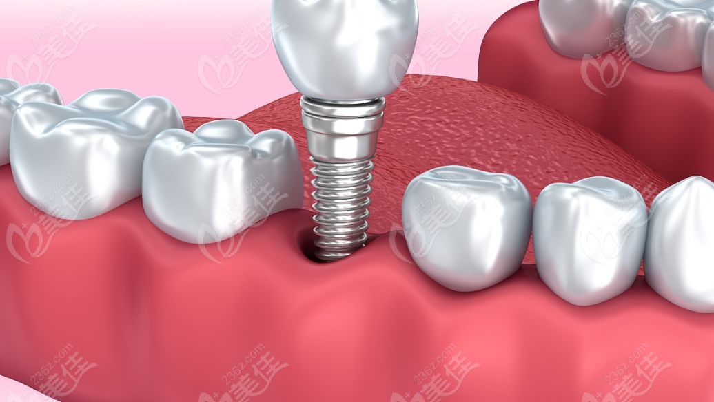 2025年种植牙价格会不会下跌www.236z.com