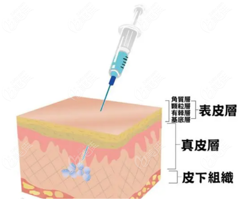 优妮金玻尿酸