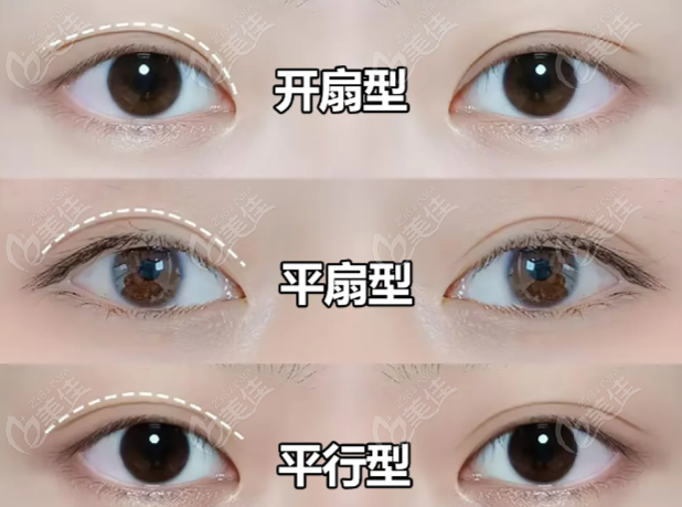 郑州鲁华双眼皮实例图展示