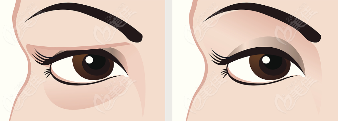 北京眼袋修复好的医院修复眼袋成效对比图片