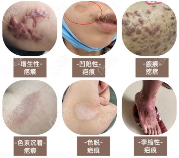 于艳菊皮上皮下联合治疗