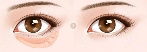 沈陽微創(chuàng)去眼袋正規(guī)醫(yī)院排名前十：都是沈陽微創(chuàng)不開刀祛眼袋好的整形醫(yī)院