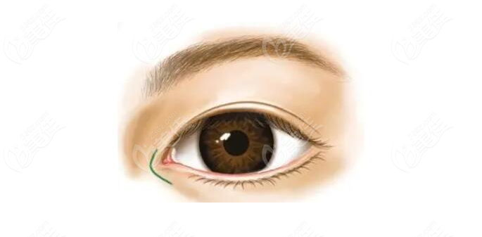 宁波开眼角修复哪家医院好？