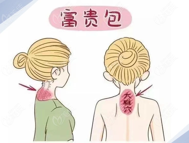 李方偉醫(yī)生富貴包消除做得好價(jià)格不貴