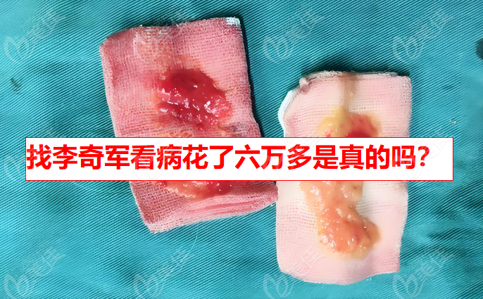 找李奇军看病花了六万多是真的吗？