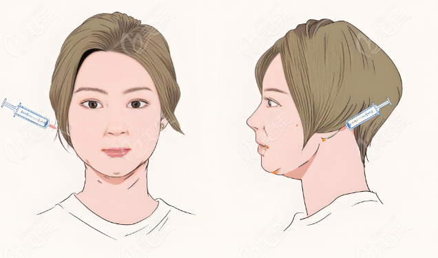 北京嘉禾医疗美容面部吸脂实例卡通图