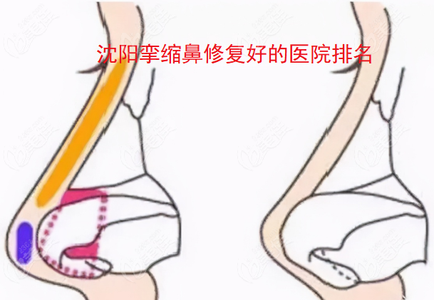 沈陽(yáng)攣縮鼻修復(fù)好的醫(yī)院排名：都是硅膠隆鼻/自體軟骨隆鼻攣縮鼻修復(fù)好的醫(yī)院