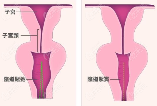 5D胶原再生紧致术成效对比图片