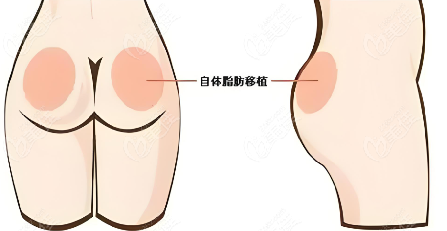 北京自体脂肪丰臀好的医生排名介绍