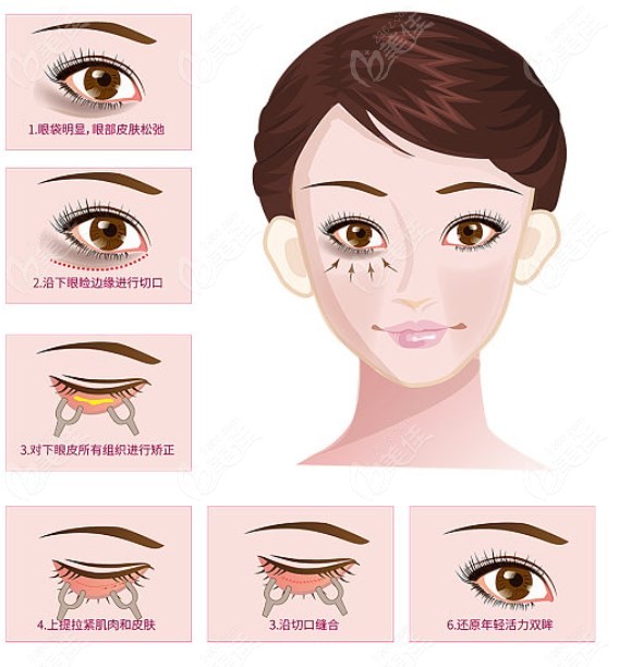 成美王立鹏眼袋修复实例成效