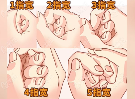做过3d生物束带紧缩术的手术经历