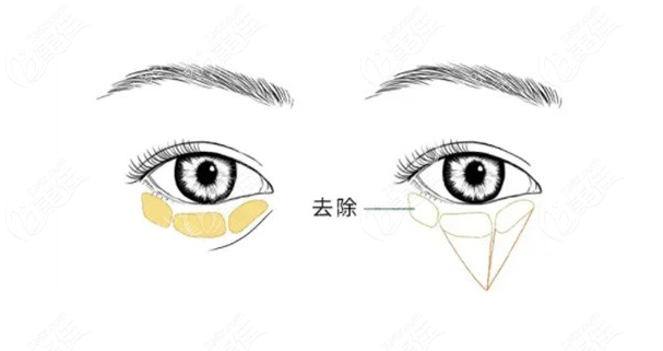 	成都不开刀去眼袋哪家好?(Top5公布)健丽医美/达芬奇怎么选?价格口碑大PK