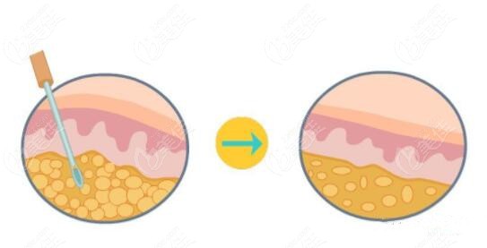 沈阳腰腹吸脂哪家医院好一点？想瘦肚子