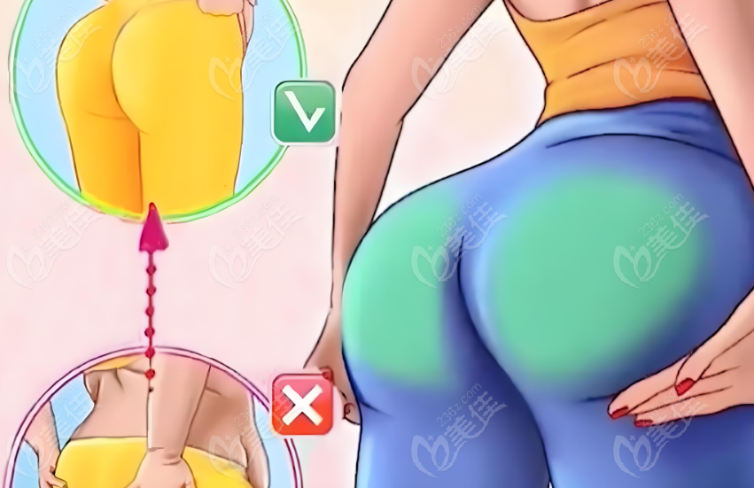 妈妈臀吸脂